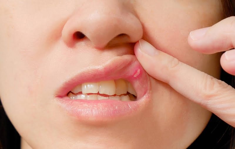 سرطان-الفم-الأعراض-والأسباب